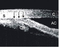 appositionally closed angle in an eye with plateau iris syndrome