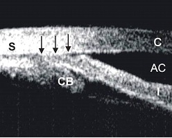 UBM image of an eye with plateau iris syndrome after laser peripheral iridotomy.