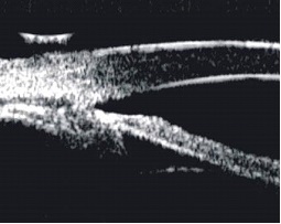 UBM image of the same eye after ALPI to open the drainage angle.