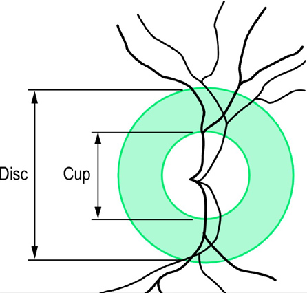 Cup to Disc Ratio