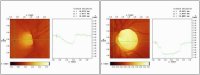 Hrt Cup Shape Normal Vs Glaucoma