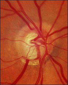 optic nerve fundus photo